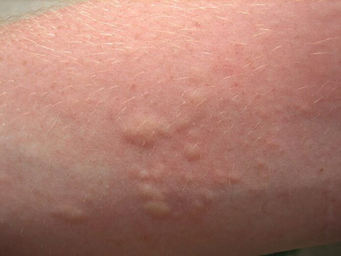 itchy allergic rashes may be symptoms of ascariasis