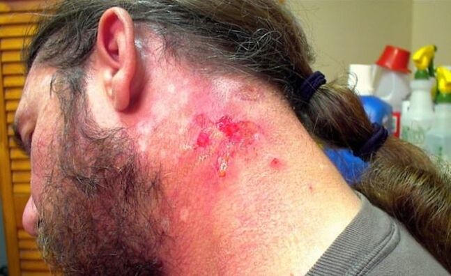 Bleeding wound on neck with Morgellons virus